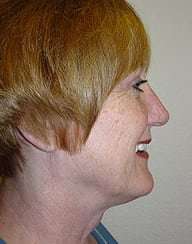 Rhinoplasty Before & After Patient #200