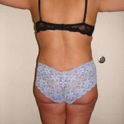 Liposuction Before & After Patient #1007