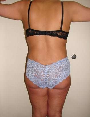 Liposuction Before & After Patient #1007