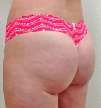 Brazilian Butt Lift Before & After Patient #1013