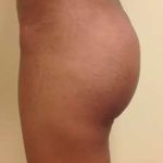 Brazilian Butt Lift Before & After Patient #1027