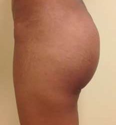 Brazilian Butt Lift Before & After Patient #1027