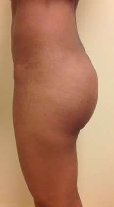 Brazilian Butt Lift Before & After Patient #1027