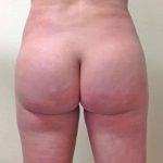 Brazilian Butt Lift Before & After Patient #1030