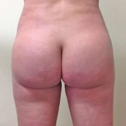 Brazilian Butt Lift Before & After Patient #1030