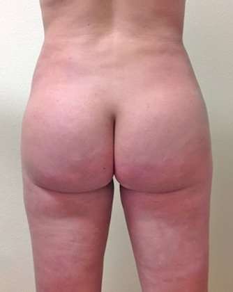 Brazilian Butt Lift Before & After Patient #1030