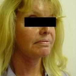 Laser Resurfacing Before & After Patient #121