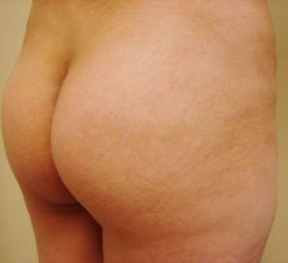 Brazilian Butt Lift Before & After Patient #1052