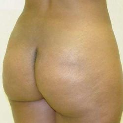 Brazilian Butt Lift Before & After Patient #1055