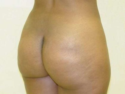 Brazilian Butt Lift Before & After Patient #1055