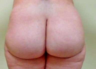Brazilian Butt Lift Before & After Patient #1062