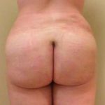 Brazilian Butt Lift Before & After Patient #1065