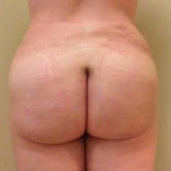 Brazilian Butt Lift Before & After Patient #1065