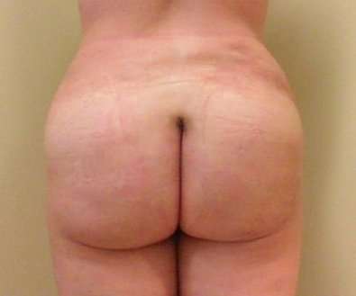 Brazilian Butt Lift Before & After Patient #1065