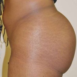 Brazilian Butt Lift Before & After Patient #1072
