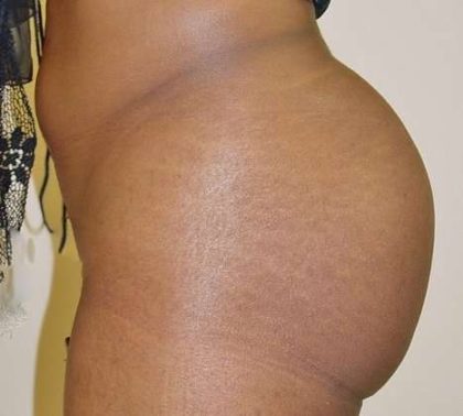 Brazilian Butt Lift Before & After Patient #1072