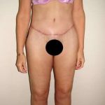 Body Contouring Before & After Patient #1076