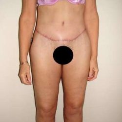 Body Contouring Before & After Patient #1076