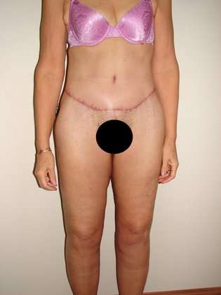 Body Contouring Before & After Patient #1076