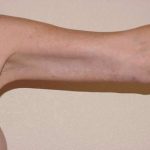 Arm Lift Before & After Patient #1082
