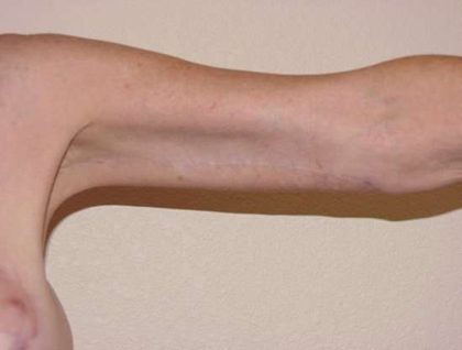 Arm Lift Before & After Patient #1082