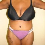 Abdominoplasty Before & After Patient #1098