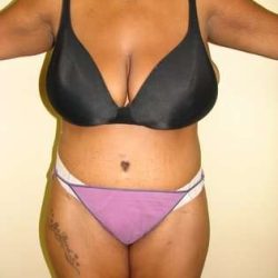 Abdominoplasty Before & After Patient #1098