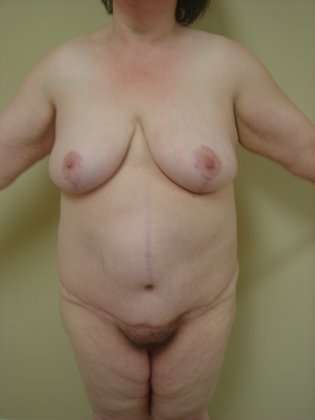Abdominoplasty Before & After Patient #1110