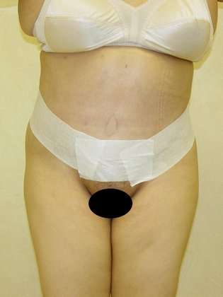 Abdominoplasty Before & After Patient #1113