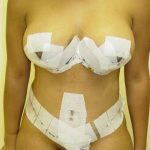 Abdominoplasty Before & After Patient #1116