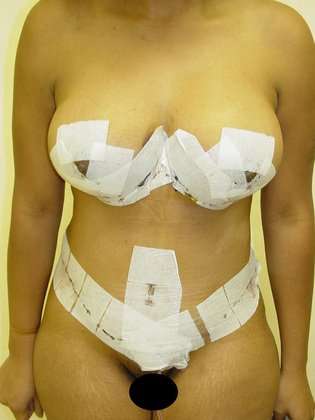 Abdominoplasty Before & After Patient #1116