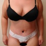 Abdominoplasty Before & After Patient #1120