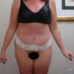 Abdominoplasty Before & After Patient #1127