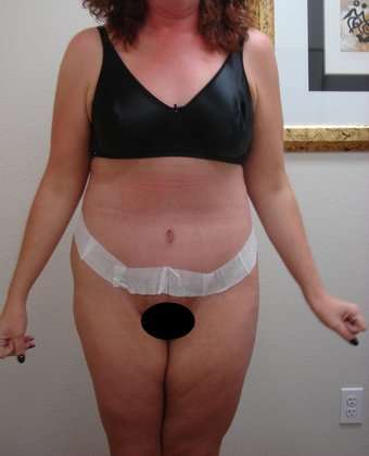 Abdominoplasty Before & After Patient #1127