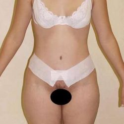 Abdominoplasty Before & After Patient #1130