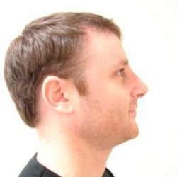 Rhinoplasty Before & After Patient #213