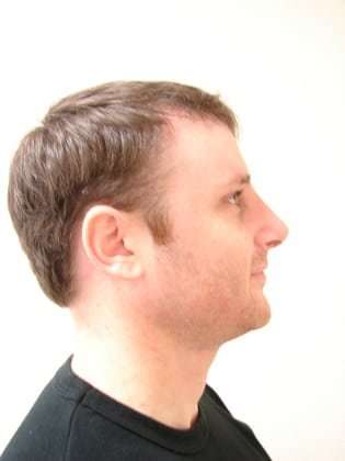 Rhinoplasty Before & After Patient #213