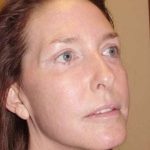 Laser Resurfacing Before & After Patient #133