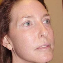 Laser Resurfacing Before & After Patient #133