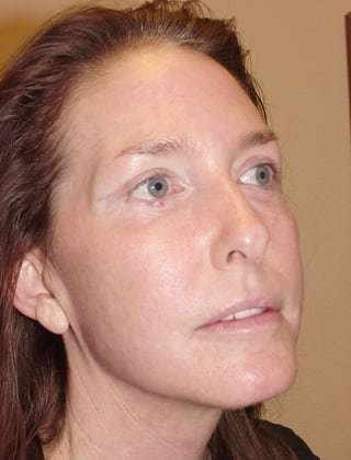 Laser Resurfacing Before & After Patient #133