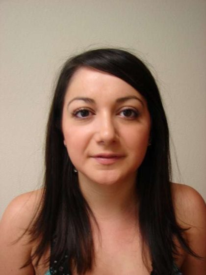 Rhinoplasty Before & After Patient #230
