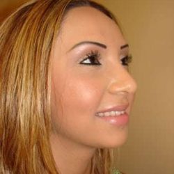 Rhinoplasty Before & After Patient #233