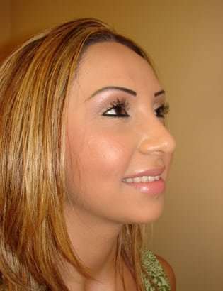 Rhinoplasty Before & After Patient #233