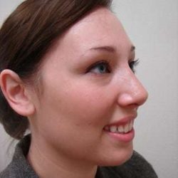 Rhinoplasty Before & After Patient #236