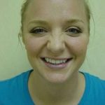 Rhinoplasty Before & After Patient #241