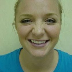 Rhinoplasty Before & After Patient #241