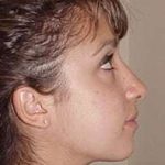 Rhinoplasty Before & After Patient #246