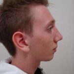 Rhinoplasty Before & After Patient #250