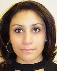 Rhinoplasty Before & After Patient #263