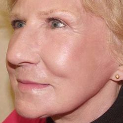 Laser Resurfacing Before & After Patient #136